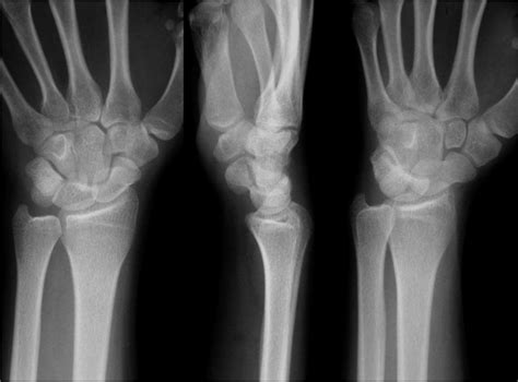 Normal Wrist X Ray Lateral