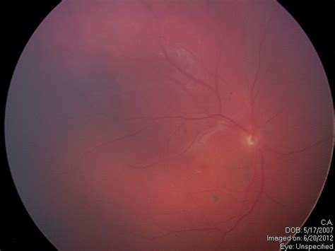 Diffuse Choroidal Hemangioma - Retina Image Bank