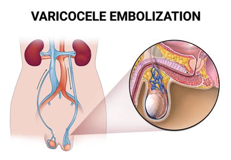 Varicocele Embolization - Vein & Endovascular Medical Care