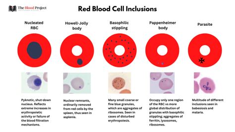 Red Cell Inclusions • The Blood Project