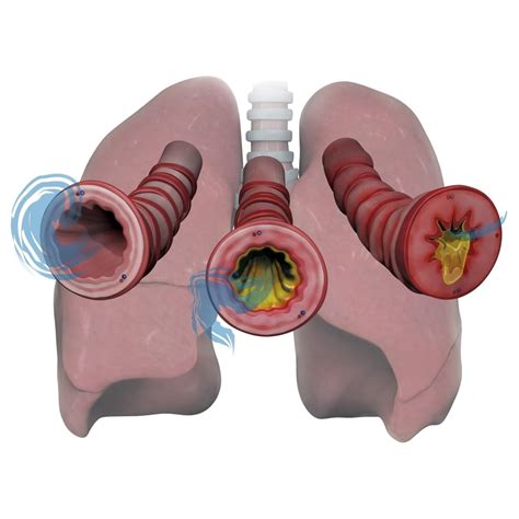 Lungs and bronchioles depicting asthma stages of inflammation and mucus ...