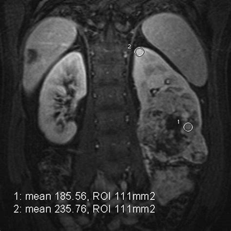 Renal Cell Carcinoma: Dynamic Contrast-enhanced MR Imaging for ...