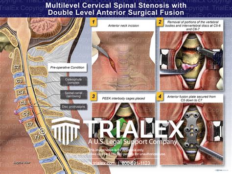 Multilevel Cervical Spinal Stenosis wit Double Level Anterior Surgical ...