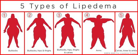 5types-lipedema - Lipedema Simplified