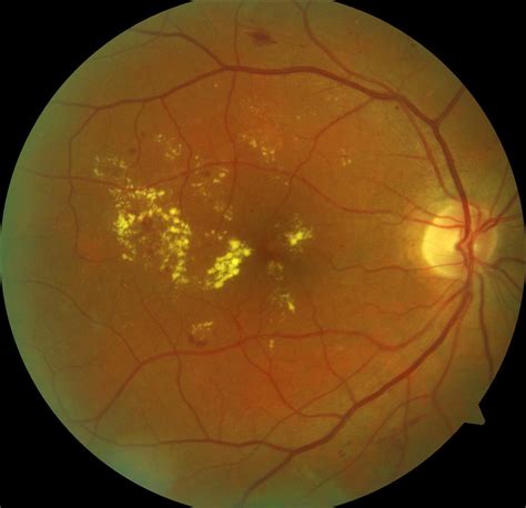 Diabetic Retinopathy Fundus Photo