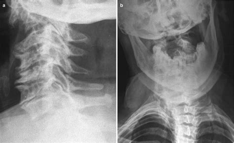 Atlanto-Axial Osteoarthritis | Radiology Key