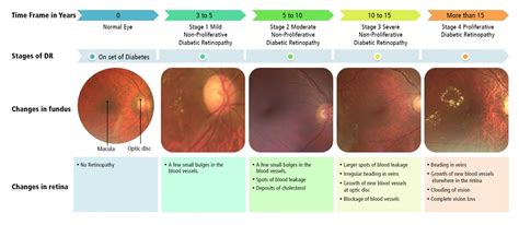 Diabetic Retinopathy Grading