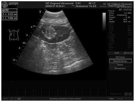 Xp11.2 translocation renal cell carcinoma with egg-shell calcification ...