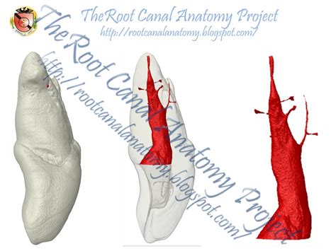 The Root Canal Anatomy Project: Two-Rooted Maxillary Central Incisor