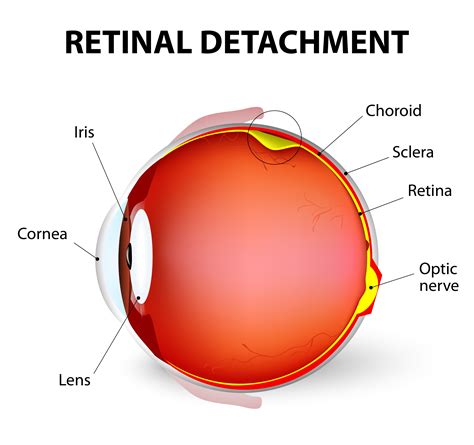 Retinal Detachment Surgery - Vitrectomy RS