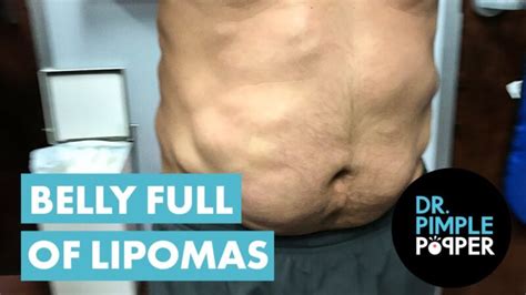 Dr Pimple Popper Removes Belly Full of Lipomas - Pimple Popping Videos