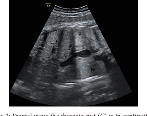 Figure 2 from A Case of Ultrasound Diagnosis of Fetal Hiatal Hernia in ...