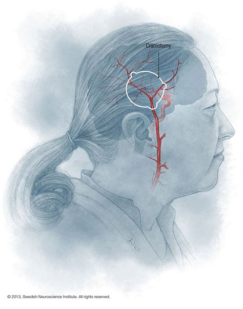 Moyamoya Disease - SeattleNeurosciences.com