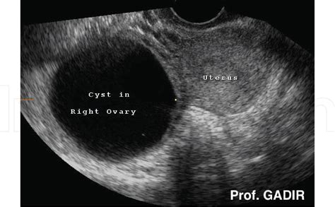 √ Ovarian Cancer Ultrasound Ovarian Cyst : Transvaginal Ultrasonography ...