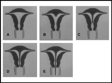 In August of 2017, I was diagnosed with a Complete Vaginal and Uterine ...