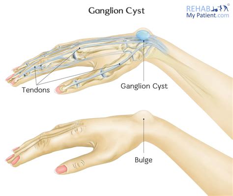 Wrist articles | Rehab My Patient