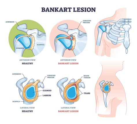 Bankart Lesion | Symptoms, Causes and Exercises