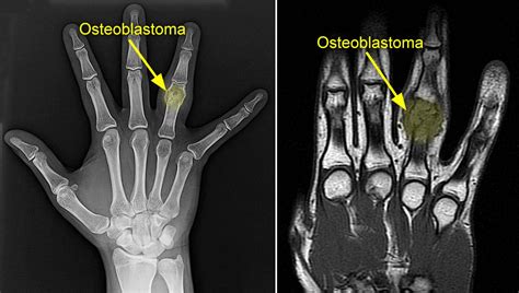 Osteoid Osteoma Spine Mri