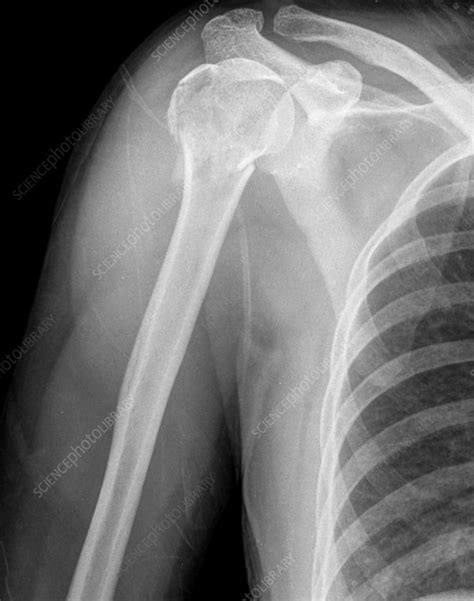 Humerus fracture, X-ray - Stock Image - F036/0229 - Science Photo Library