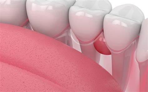 Gum Cysts | Causes, Symptoms and Treatment Options