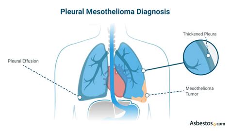 What Is Pleural Mesothelioma? Full Overview & What to Expect