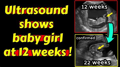 12 Week Ultrasound Girl Vs Boy