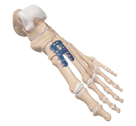 Arthrex - Lisfranc Arthrodesis