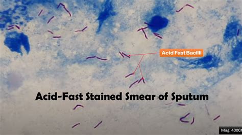 Acid-Fast Stain: Introduction, Principle, Procedure, Result Interpretation