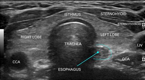 Normal Thyroid Ultrasound