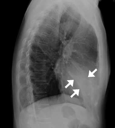 Middle Lobe Syndrome; Brock's Syndrome