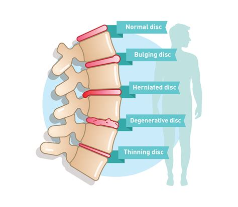 Herniated Disc Symptoms