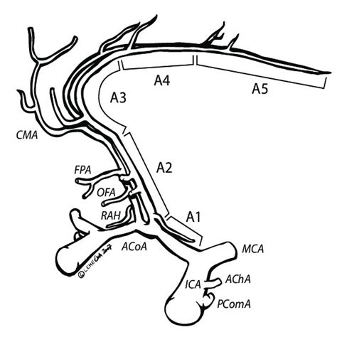 (PDF) Distal Anterior Cerebral Artery Aneurysms