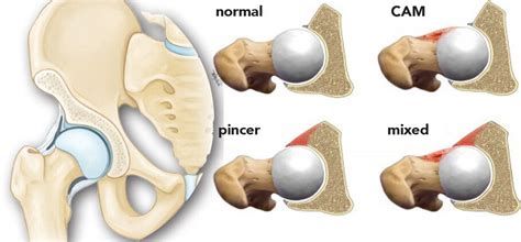 Femoroacetabular Impingement (FAI) - CNOS