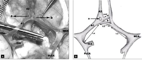 Figure 1 from Two variations of the anterior communicating artery: a ...