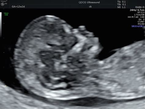 12 Week Scan Perth Pregnancy Ultrasound At 12 Weeks Qdos Perth | Images ...