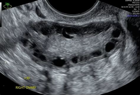 Polycystic Ovaries (PCOS) Ultrasound Sydney | USC