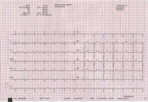 Normal Ecg Tracing