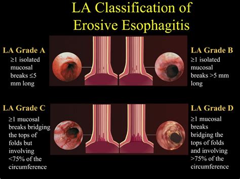 Table 3 from Diagnosis and initial management of gastroesophageal ...