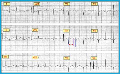 ECG Interpretation: ECG Blog #152 (QTc – ECG Lists – Sinus Rhythm)