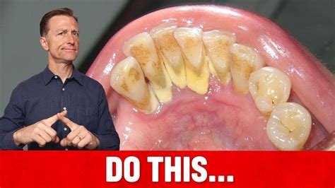 The #1 Top Remedy for Dental Plaque (TARTAR) - YouTube