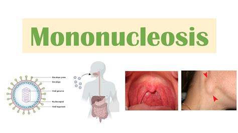 Infectious Mononucleosis (Mono) | Epstein-Barr Virus, Transmission ...