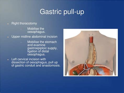 PPT - Colonic interposition for benign oesophageal disease. PowerPoint ...