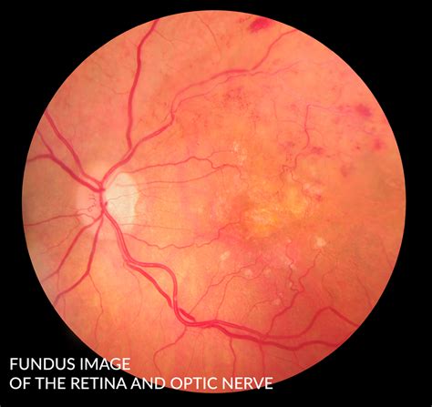 Vitreo-Retinal Diseases and Conditions - Saratoga Ophthalmology