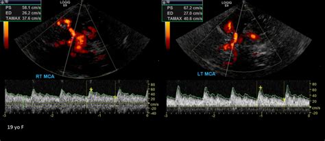 Transcranial Doppler | Medical ultrasound, Vascular ultrasound, Ultrasound