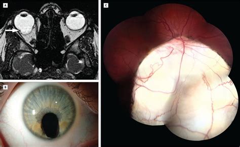 Uveal Coloboma. JAMA Ophthalmol. 2013;131(10):1274. doi:10.1001 ...