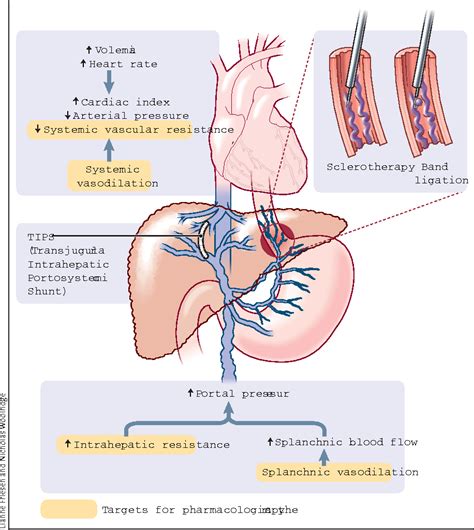 Esophageal Varices Portal Hypertension