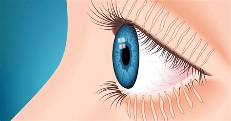 Meibomian Gland Dysfunction - All About Vision