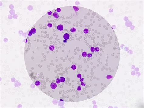 What do Leukocytes in Urine mean?