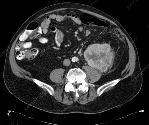 Renal carcinoma, CT scan - Stock Image - C039/3835 - Science Photo Library