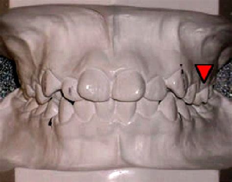 Figure 1 from Paramolar tubercle in the left maxillary second premolar ...